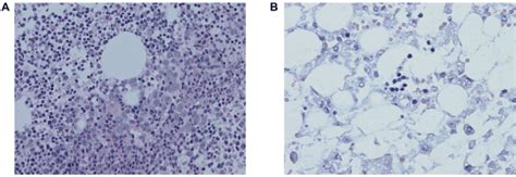 Early Development Of Bone Marrow Failure Following Severe Congenital