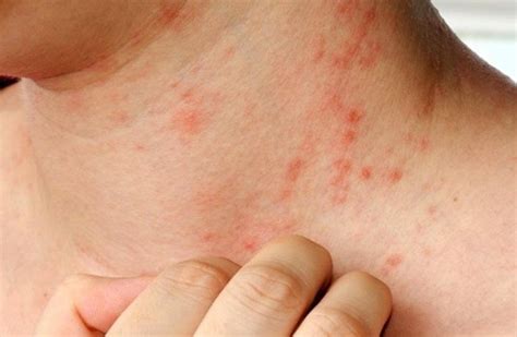 Estrés Ropa Sintética Y Alergénicos Enemigos Para La Dermatitis