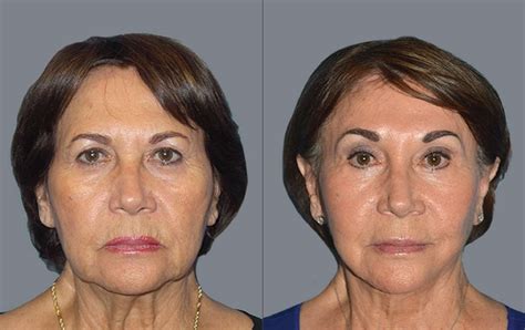 Whats The Best Age For A Facelift Buckhead Plastic Surgery Blog