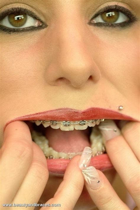 Épinglé Sur Braces And Retainers Orthodontics