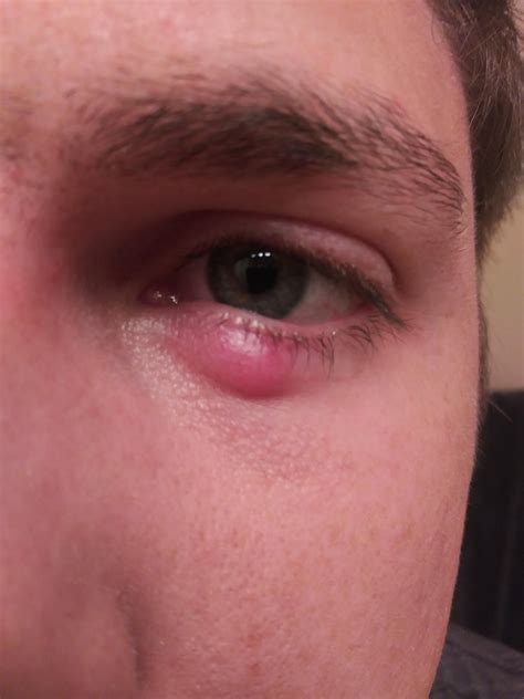 4 Month Old Stye That Wont Go Away Rpopping