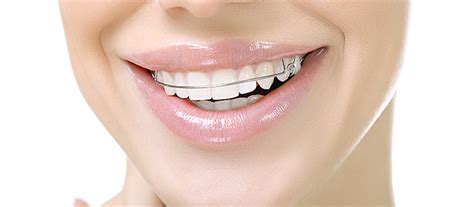 You have to wear retainers forever. 8 Tips to Keep Your Retainer Safe and Clean