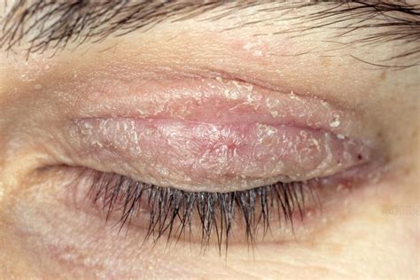 Eyelid Redness Causes Symptoms Inflamed Dry Itchy Swollen Red