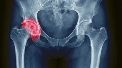 Diabetes Linked To Hip And Non Vertebral Bone Fractures Clinical