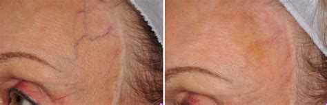 Laser Vein Treatment In Nashville Curcio Dermatology