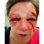 Horrific Injuries Of Woman 50 Battered At Her Home By Violent Robber 