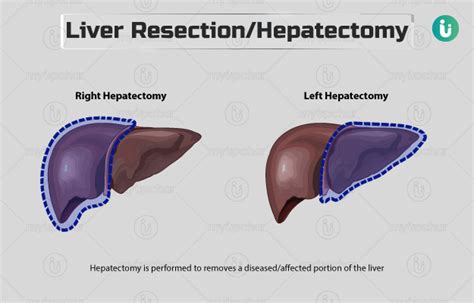 Liver Resectionhepatectomy Procedure Purpose Results Cost Price