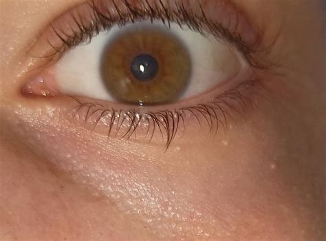 What Are These Bumps Under My Eyes Rskincareaddiction
