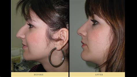 How Much Does Rhinoplasty Cost All You Need Infos