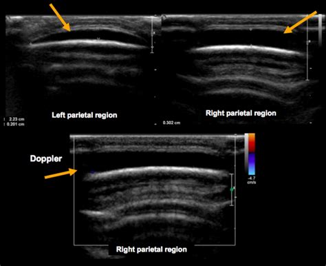 Sonographic Findings A Solid Well Demarcated Hypoechoic Subcutaneous