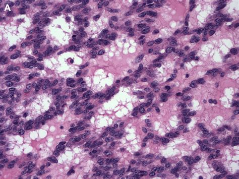 Myofibroma Myopericytoma Myoepithelioma And Myofibroblastoma Of Skin