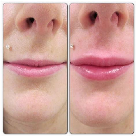 Before And After Photo Gallery Cosmetic Doctor Dublin