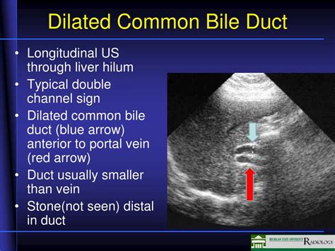 Ppt Biliary Disease Powerpoint Presentation Free Download Id1710775