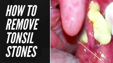 Tonsil Stones Removal Causes And Treatment At Home Compliation 2021
