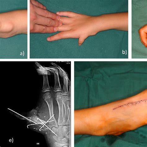 Extensor Indicis Proprius Eip Transfer With Subperiosteal Fixation