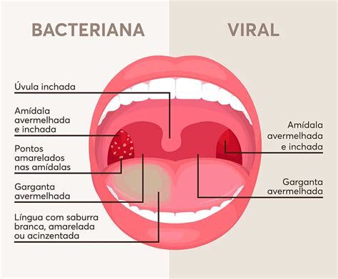 Boca Abierta Normal Y Amigdalitis Bacteriana Y Viral Angina De Images
