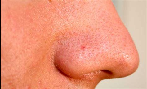 How To Reduce Large Open Pores On The Nose