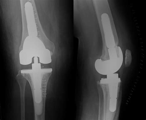 Knee Replacement Sussex Knee Surgery