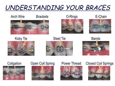 This Is A Great Resource If You Have Braces Itll Help You Better