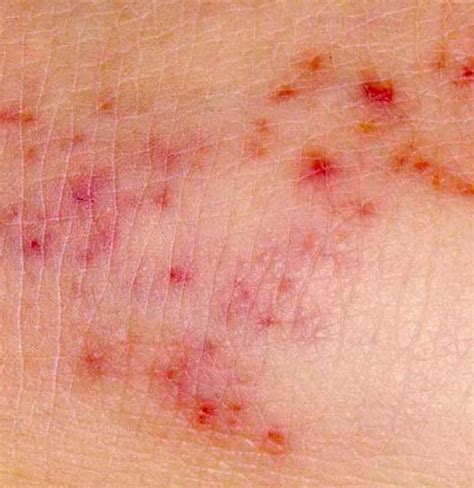 Skin Rash Adults Types