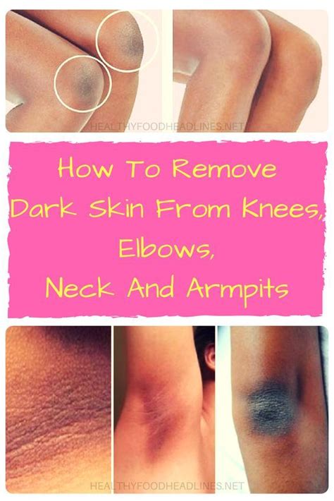 How To Remove Dark Skin From Knees Elbows Neck And Armpits Dark