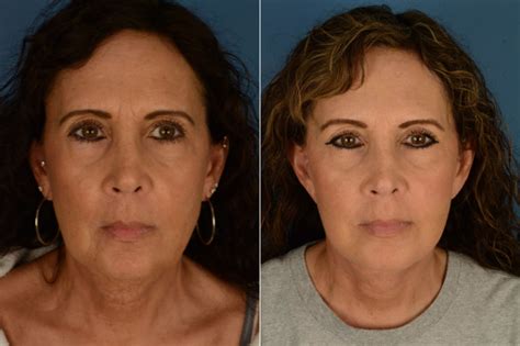 The Uplift™ Lower Face And Neck Lift Photos Naples Fl Patient 21415