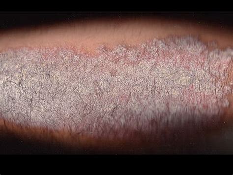 Experimental Secukinumab Clears Psoriasis In Some Patients