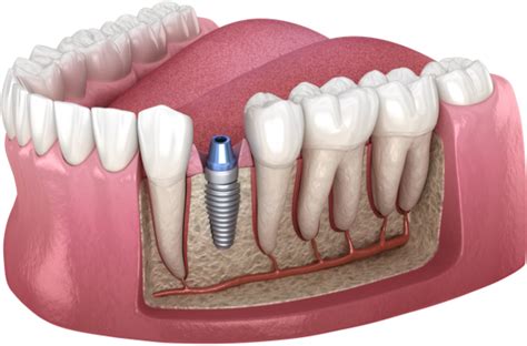 Dental implants | Montréal Maxillo-Facial