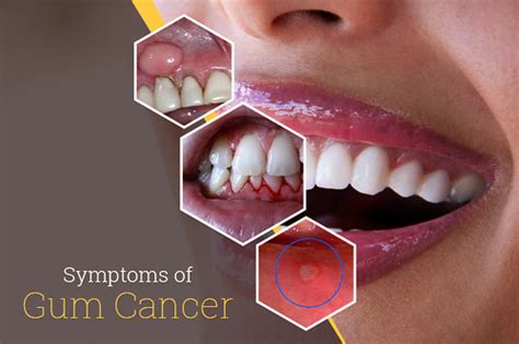 Top Symptoms Of Gum Cancer Now A Days Gum Cancer Is One Of Flickr