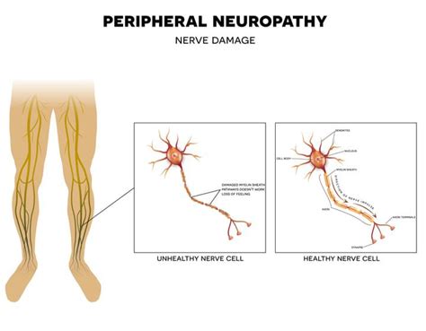 Peripheral Neuropathy Can Be Treated At Premier Neurology In Stuart Fl