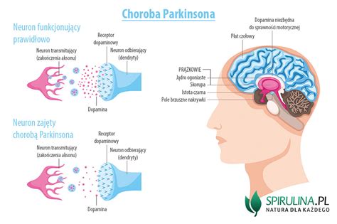 Choroba Parkinsona Algi Spirulina I Chlorella