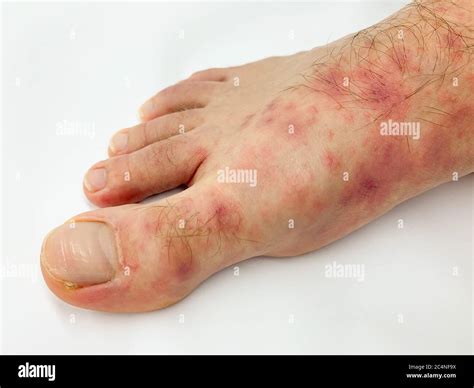 Close Up Of Males Foot And Toes With Red Rash Desease On A White