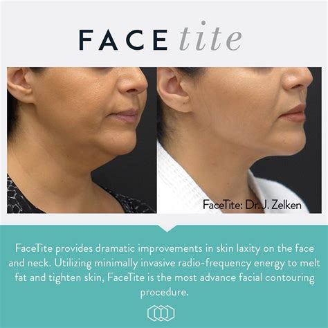Facial Conturing Done Right 🙌 ⁣ Facetite Is The Most Advanced Facial