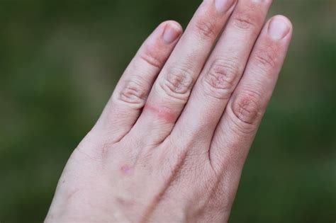 Red Bumps On Fingers Stress 02