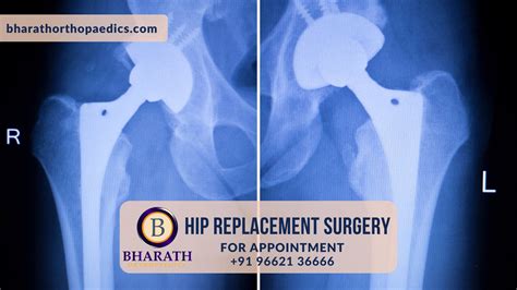 Pin On Hip Replacement Surgery