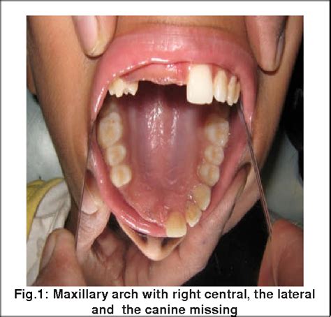 Figure 4 From Regional Odontodysplasia A Unique Dental Anomaly With An