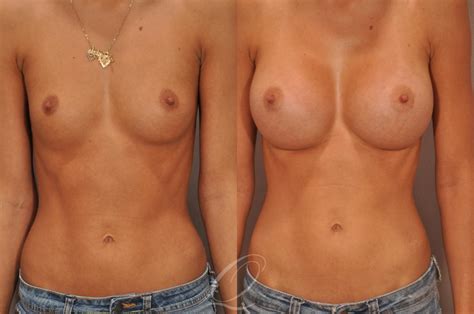 Breast Augmentation Before After Photos Patient 99 Serving