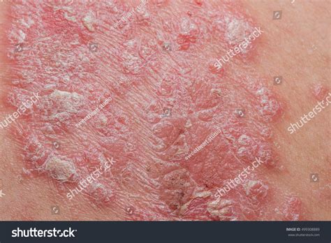Psoriasis Skin Psoriasis Autoimmune Disease That Stock Photo 499308889