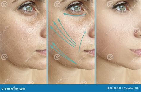 Woman Face Wrinkles Before And After Correction Cosmetology