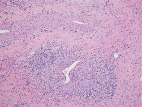 Pathology Outlines Case Of Week 351