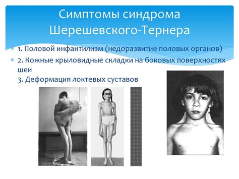 Синдром Шерешевского Тернера online presentation