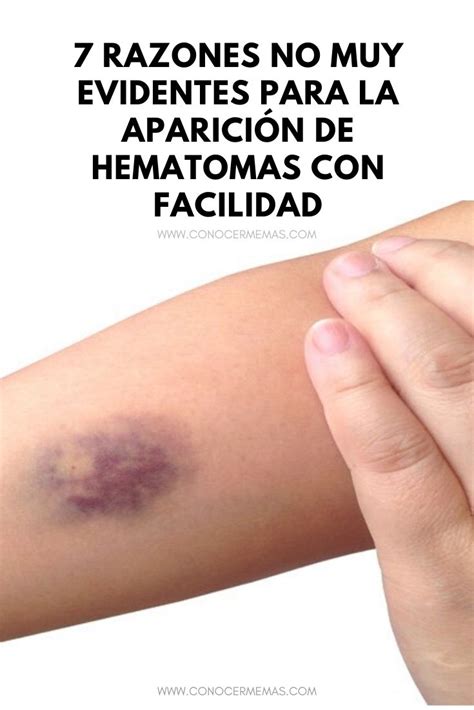 7 Razones No Muy Evidentes Para La Aparición De Hematomas Con Facilidad