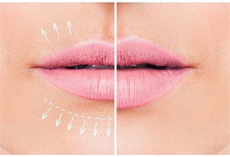 Lip Fillers Vs Fotona Liplase Whats The Difference Dr Tanja Phillips