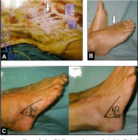 Figure 1 From Common Peroneal Nerve Palsy Caused By An Initially