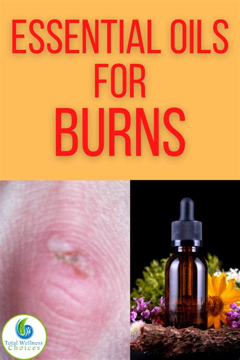 Top 5 Essential Oils For Burns Essential Oil For Burns Essential