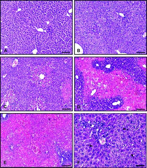 Liver Histopathology Depicting Grades Of Centrilobular Download