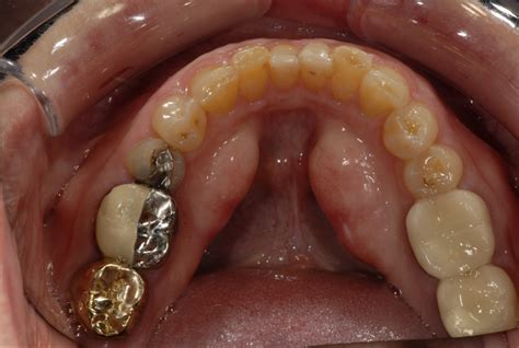 What Are Mandibular Tori News Dental Dental Problems Dentistry