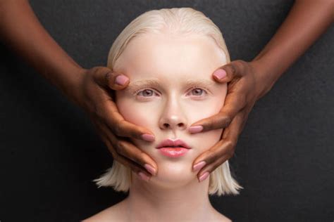African Albino Stock Photos Pictures And Royalty Free Images Istock