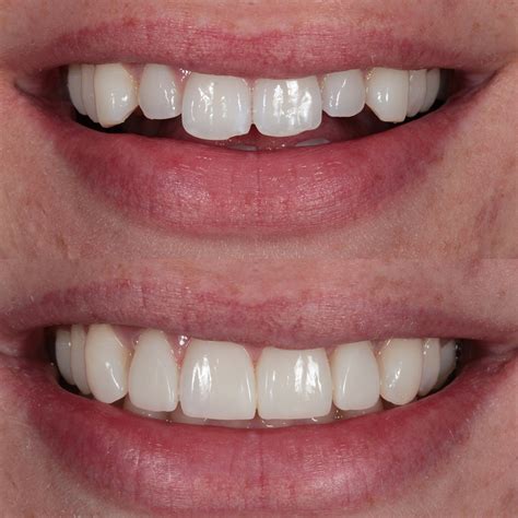 Before And After Cosmetic Bonding Smile Rooms Smile Gallery