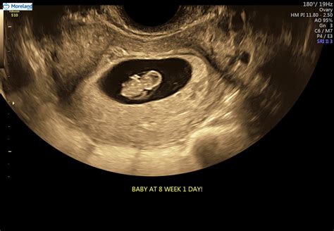 7 Weeks Pregnant Ultrasound Images Pregnantsi